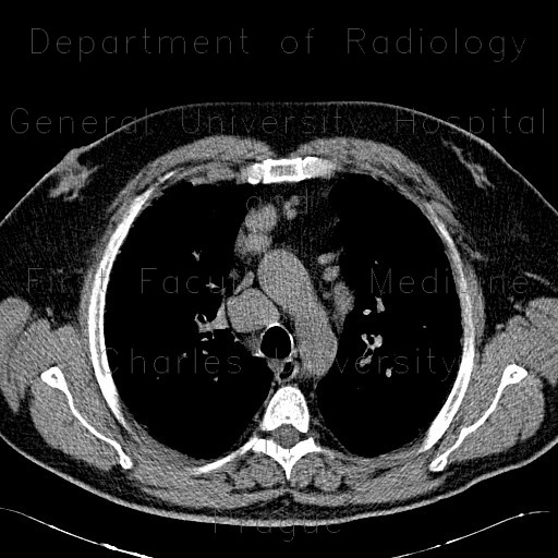 Radiology image - Sarcoidosis of lung, HRCT, hilar lymphadenopathy: Thorax, Lung, Mediastinum and pleural cavity: CT - Computed tomography