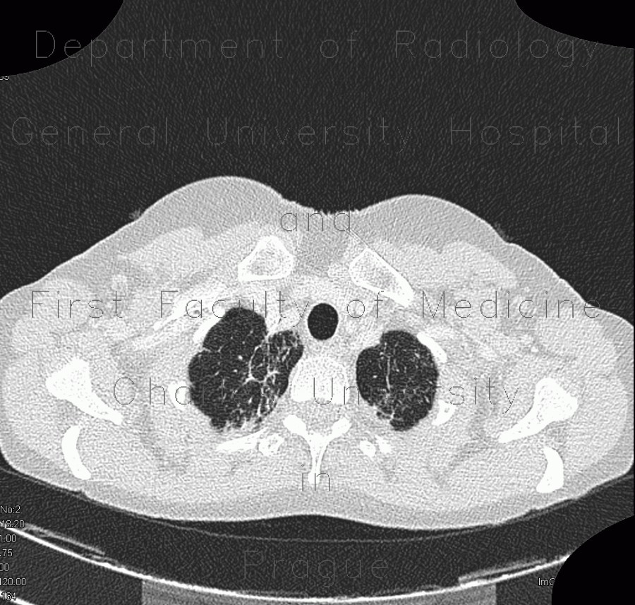Radiology image - Sarcoidosis, pulmonary sarcoidosis, stage IV: Thorax, Lung: CT - Computed tomography