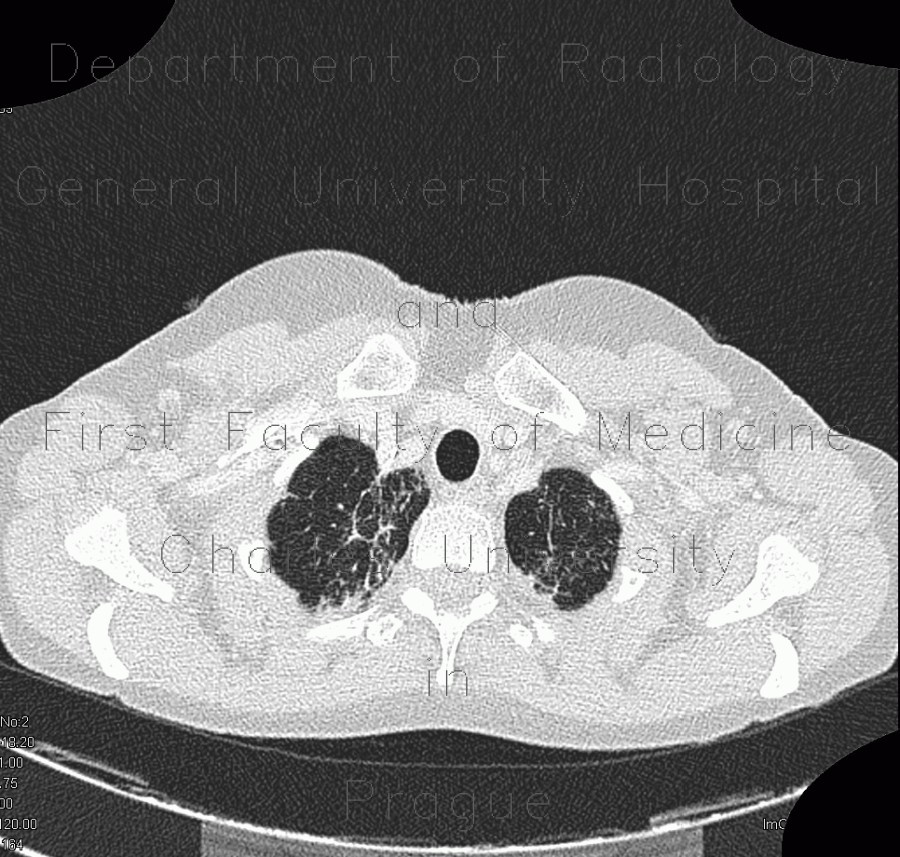 Sarcoidosis, pulmonary sarcoidosis, stage IV