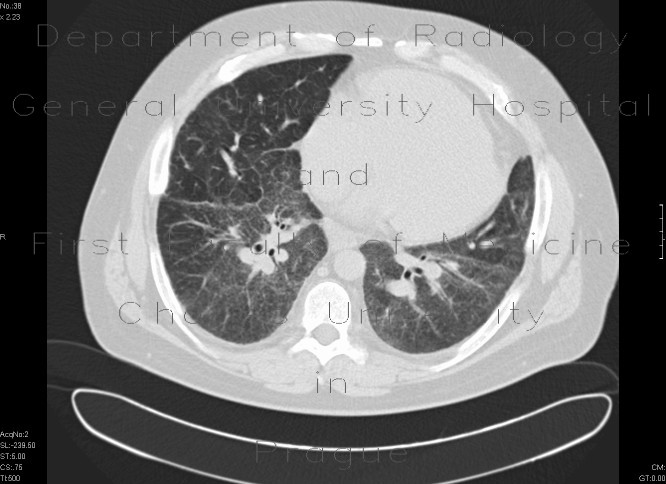 Radiology image - Sarcoidosis, second stage: Thorax, Lung, Mediastinum and pleural cavity: CT - Computed tomography