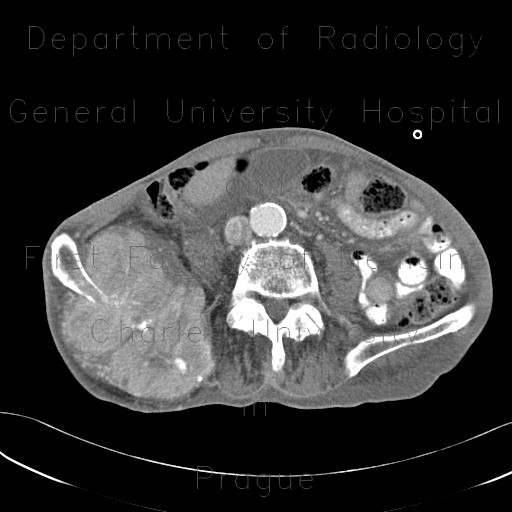 Sarcoma of iliac crest