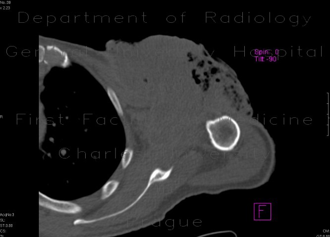 Radiology image - Sarcoma of shoulder: Extremity, Soft tissue: CT - Computed tomography