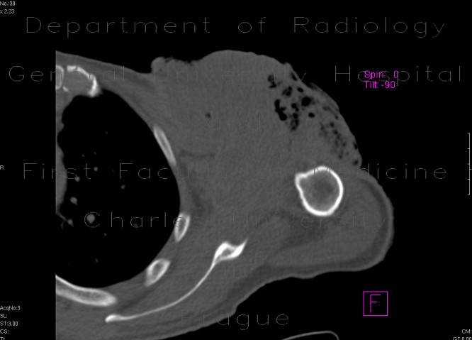 Sarcoma of shoulder