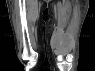 Radiology image - Sarcoma of thigh: Extremity, Soft tissue: CT - Computed tomography