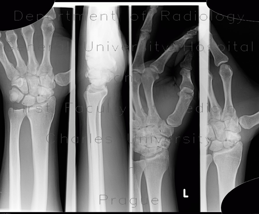 Radiology image - Scaphoid fracture, non-union, osteosynthesis with spongiosa: Extremity, Bone: X-ray - Plain radiograph