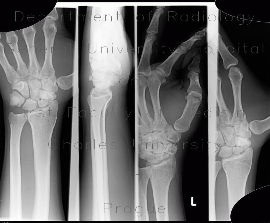 Scaphoid fracture, non-union, osteosynthesis with spongiosa