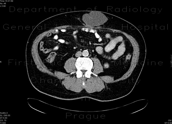 Radiology image - Scar hernia after laparoscopy: Abdomen, Peritoneal cavity: CT - Computed tomography