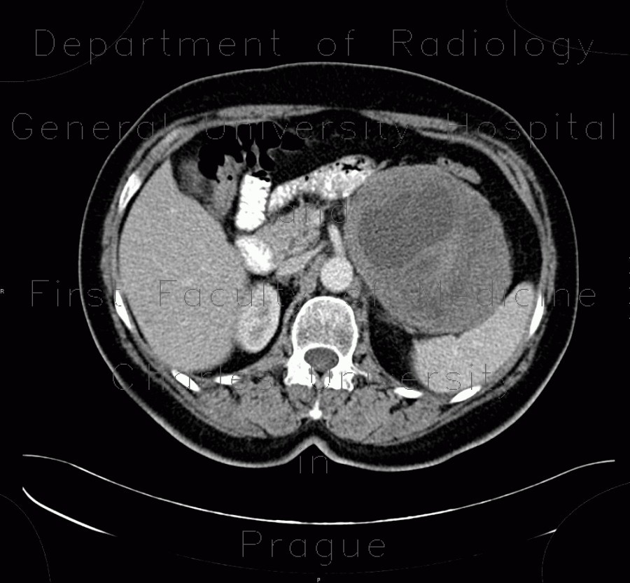 Radiology image - Schwannoma in adrenal gland, gigantic: Abdomen, Kidney and adrenals: CT - Computed tomography