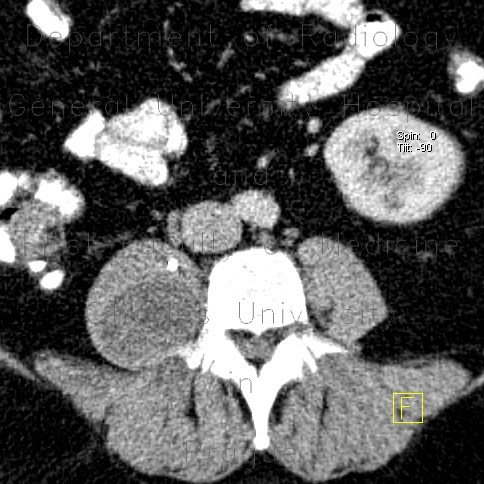 Radiology image - Schwannoma of psoas muscle: Abdomen, Spine and Axial, Brain, Soft tissue: CT - Computed tomography