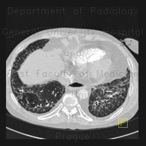 Radiology image - Sclerodermia, pulmonary fibrosis, UIP, fibrosis, oesophagus: Thorax, Lung, Oesophagus: CT - Computed tomography