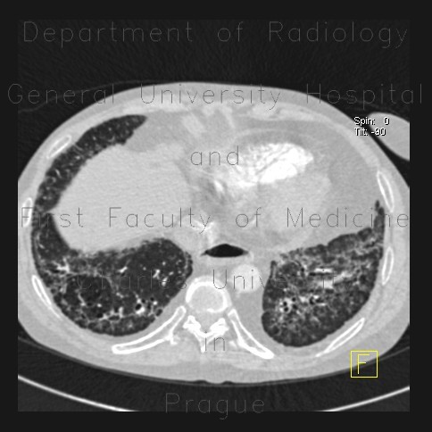 Sclerodermia, pulmonary fibrosis, UIP, fibrosis, oesophagus