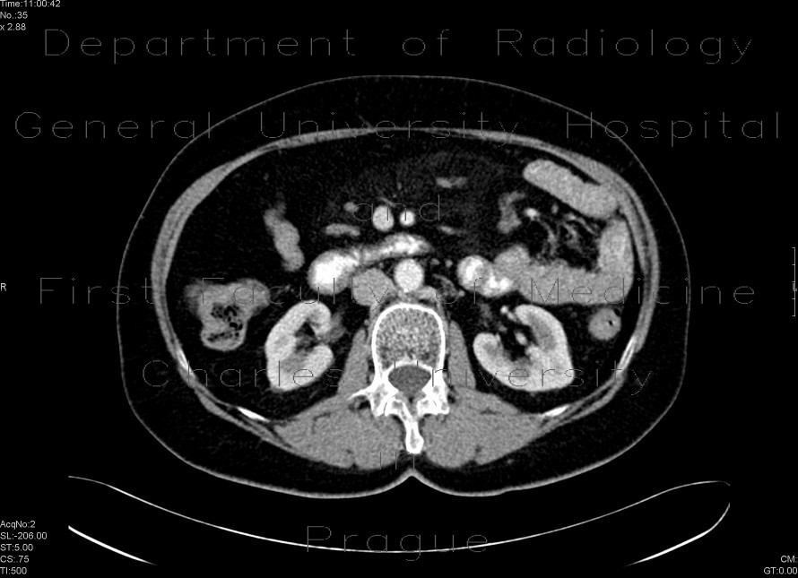Radiology image - Sclerosing mesenteritis: Abdomen, Lymphatic, Peritoneal cavity: CT - Computed tomography