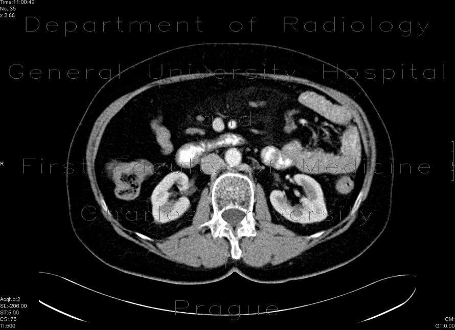 Sclerosing mesenteritis