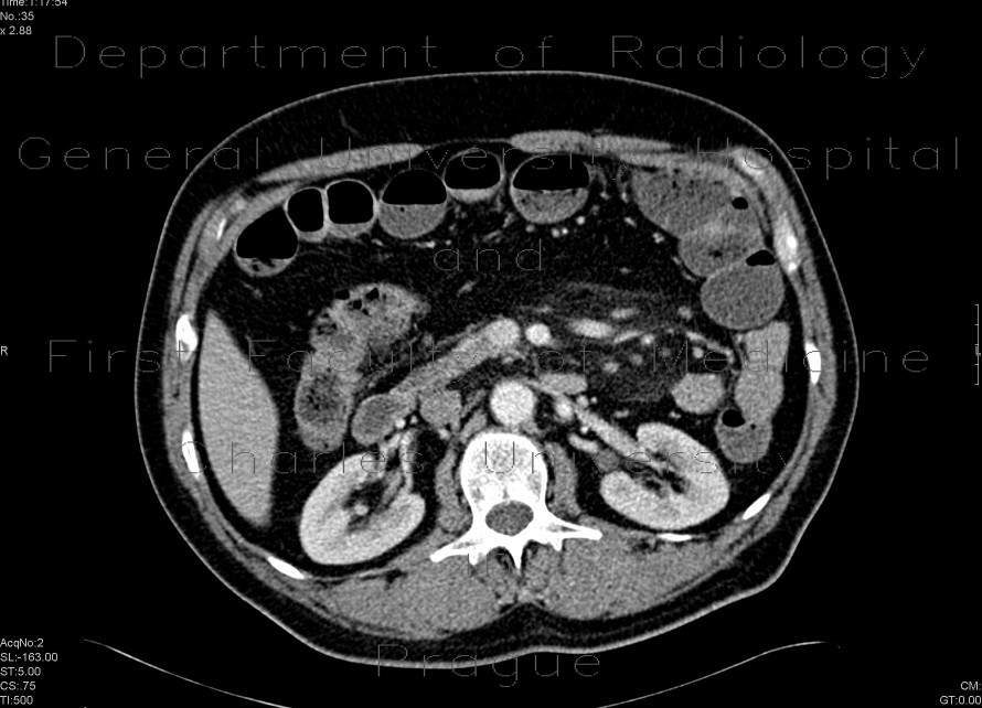 Sclerosing mesenteritis