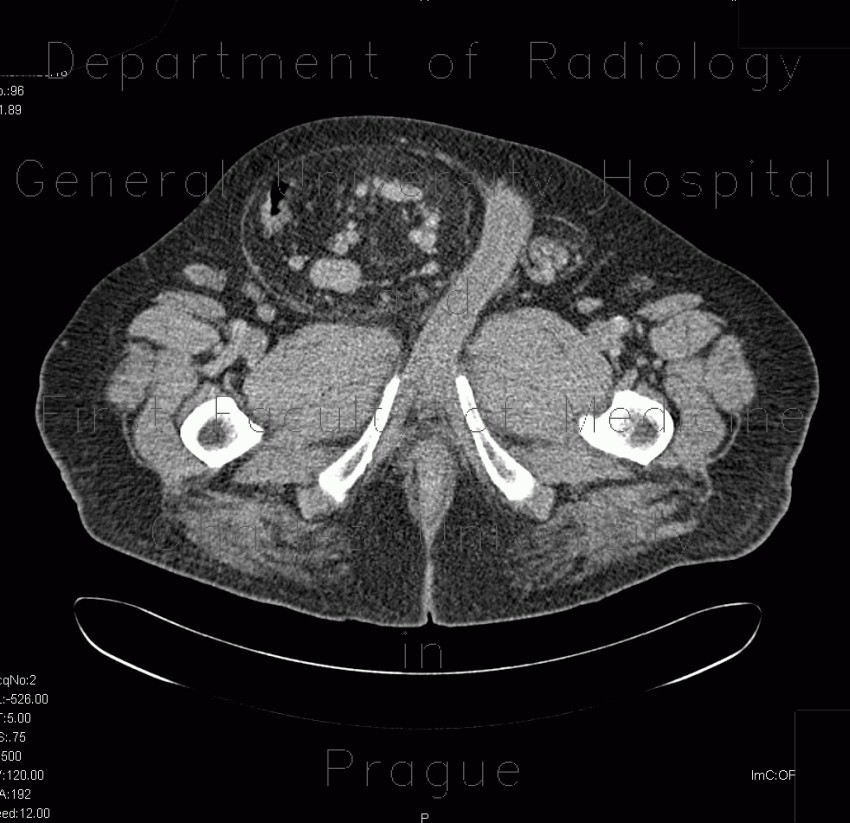 Radiology image - Scrotal hernia: Abdomen, Peritoneal cavity, Small bowel: CT - Computed tomography