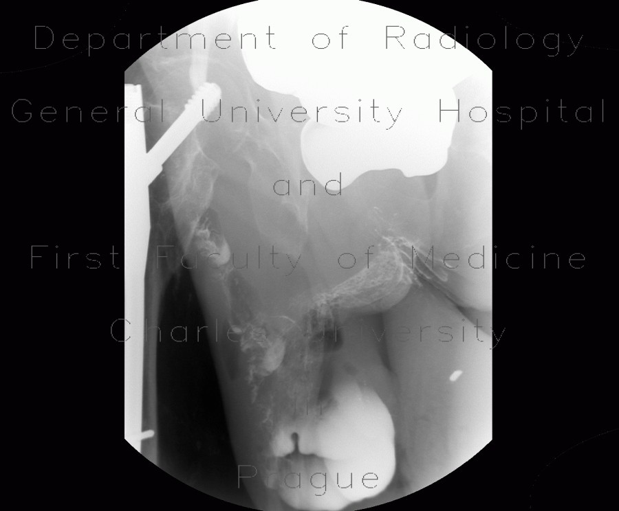 Radiology image - Scrotal hernia, cecum in scrotal hernia: Abdomen, Large bowel: RF - Fluoroscopy