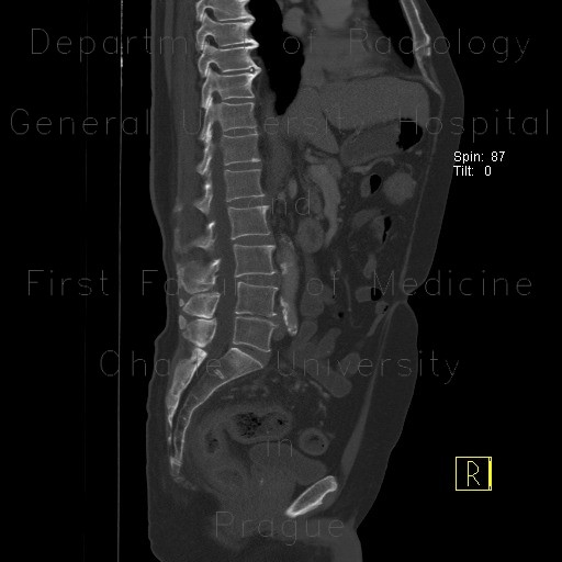 Radiology image - Separate apophysis of spinous process, lumbar vertebra: Spine and Axial, Bone: CT - Computed tomography