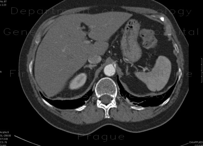 Radiology image - Separate branching of the hepatic and lienal artery from aorta: Abdomen, Vessels: CT - Computed tomography