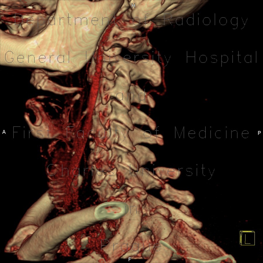 Radiology image - Separation of spinous process of C6 and C7, congenital: Spine and Axial, Bone: CT - Computed tomography