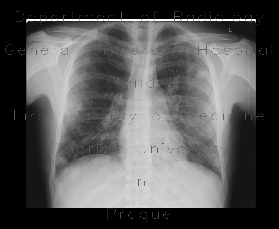 Septic emboli from infective endocarditis, lung and brain