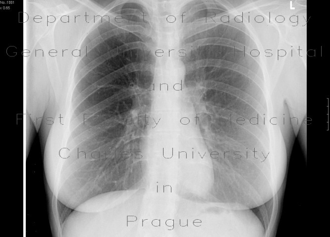 Septic emboli, lung