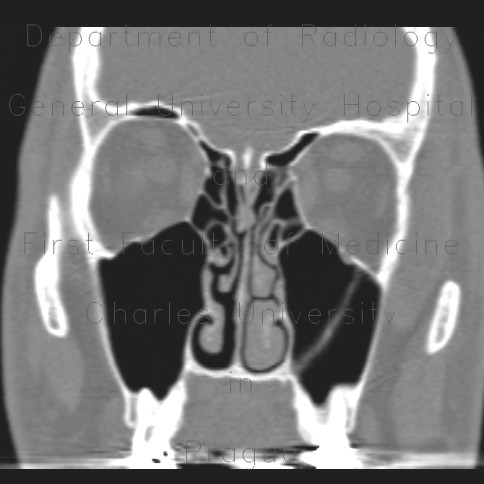 Septum of the left maxillary sinus