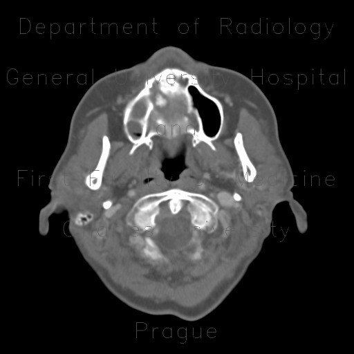 Radiology image - Sequestrum, osteomyelitis of upper jaw, maxilla: Head and Neck, Bone, Oral cavity, Sinuses: CT - Computed tomography