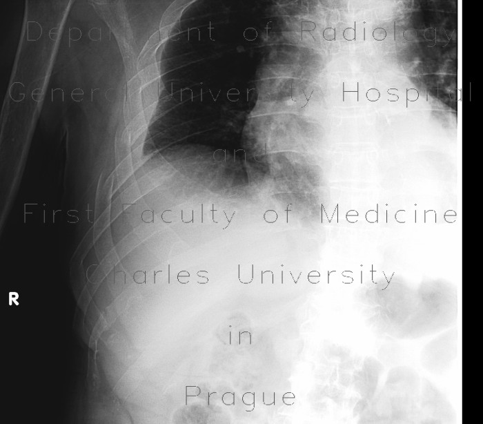 Radiology image - Serial rib fracture: Thorax, Bone, Soft tissue: X-ray - Plain radiograph