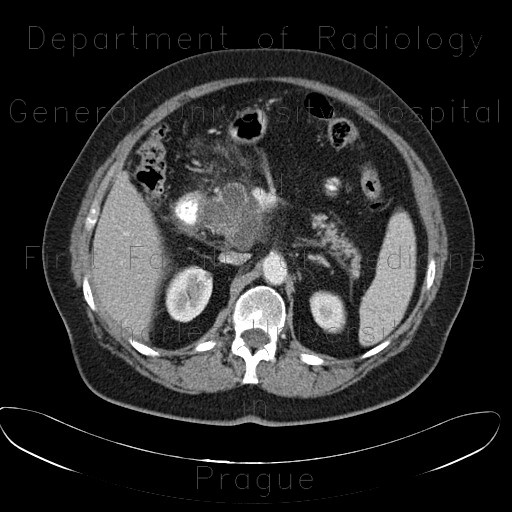Radiology image - Serous adenoma of pancreas, microcystic: Abdomen, Pancreas: CT - Computed tomography