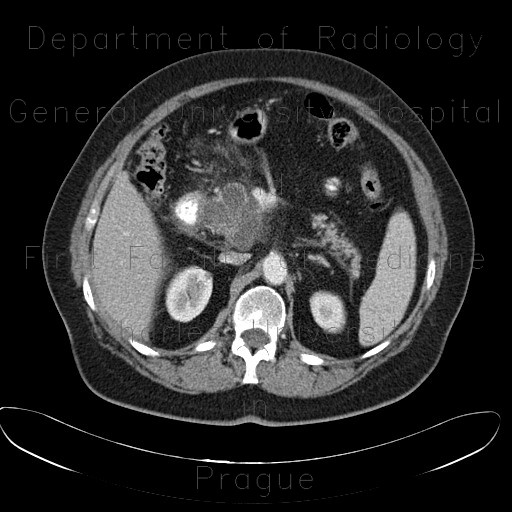 Serous adenoma of pancreas, microcystic