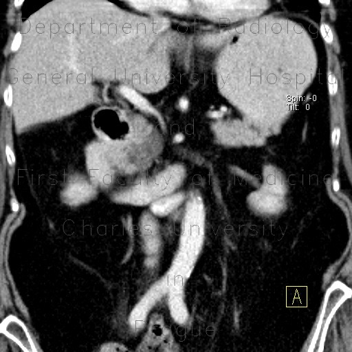 Serous cystadenoma of pancreas, cystadenoma, cystic tumour