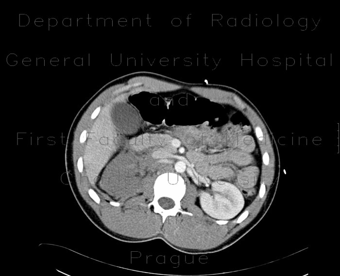 Radiology image - Severed kidney, kidney trauma: Abdomen, Kidney and adrenals: CT - Computed tomography