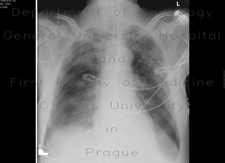 Radiology image - Shock lung, ARDS: Thorax, Lung: X-ray - Plain radiograph