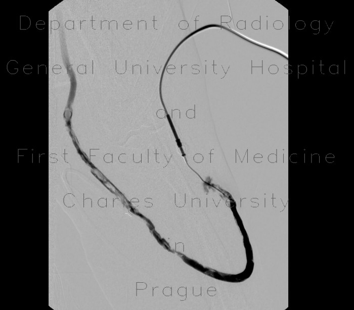 Shunt stenosis, angioplasty