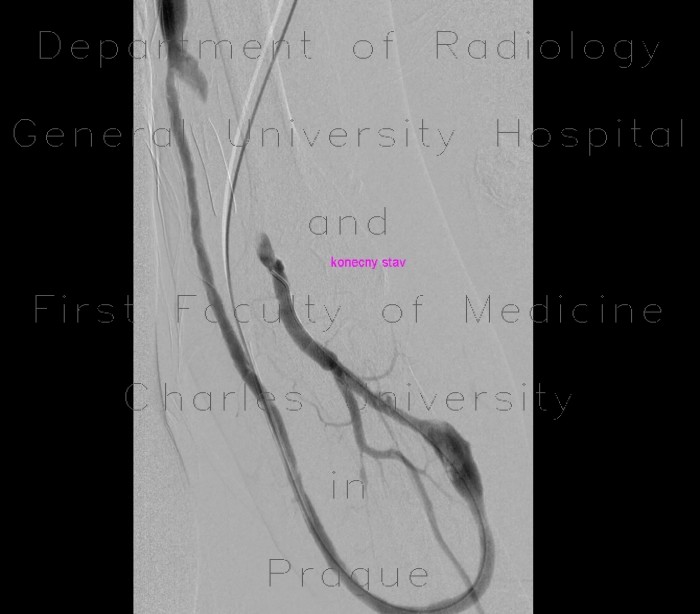 Shunt stenosis, severe, balloon angioplasty, PTA, thrombolysis