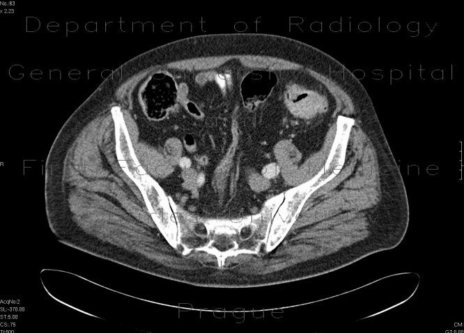Radiology image - Sigmoid carcinoma, polyp of the ascending colon: Abdomen, Large bowel: CT - Computed tomography