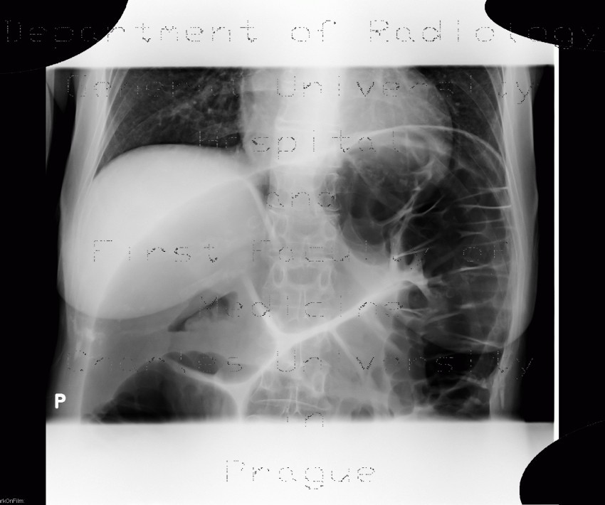Radiology image - Sigmoid volvulus, ileus: Abdomen, Large bowel: X-ray - Plain radiograph