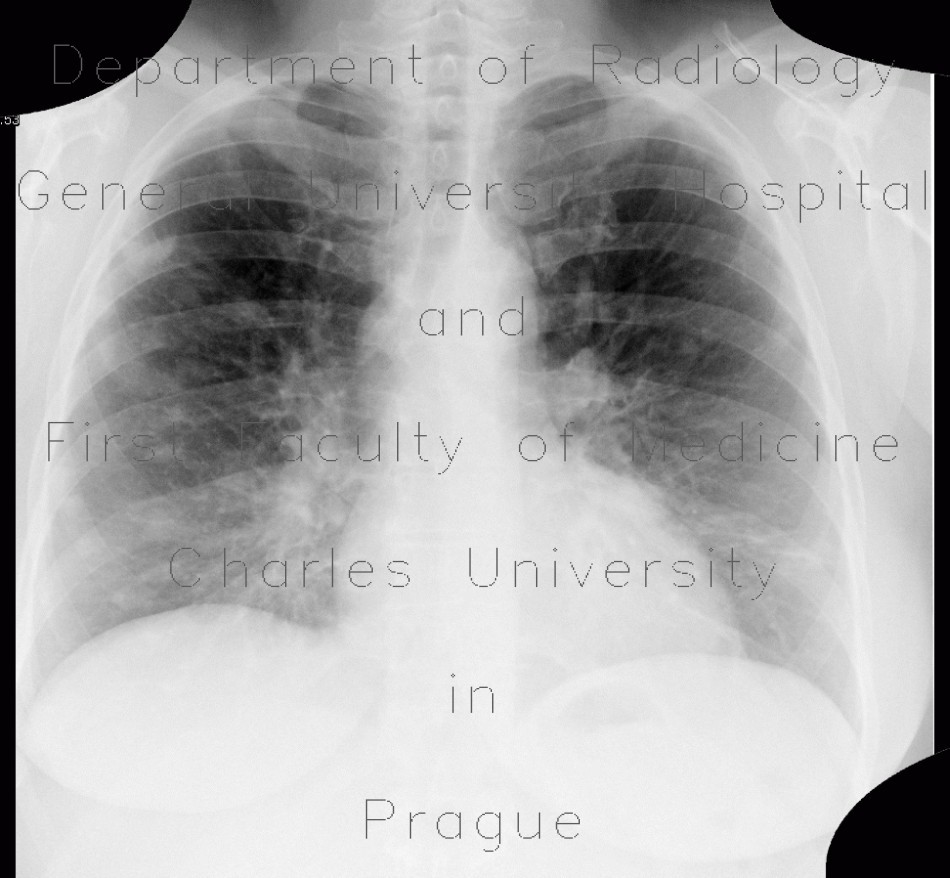 Silicosis, pulmonary silicosis