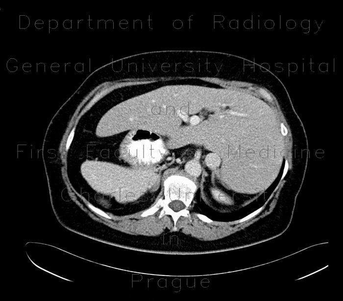 Radiology image - Situs viscerum inversus: Abdomen, Large bowel, Liver, Pancreas, Peritoneal cavity, Retroperitoneum, pelvis, Small bowel, Vessels: CT - Computed tomography