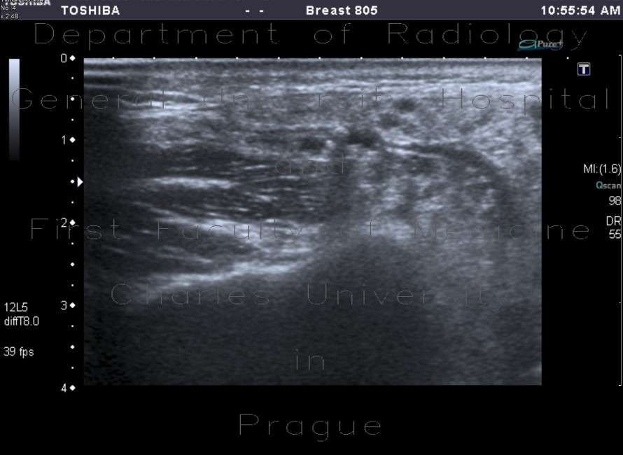Radiology image - Sjogren syndrom, sialolithiasis, parotid gland: Head and Neck, Oral cavity: US - Ultrasound
