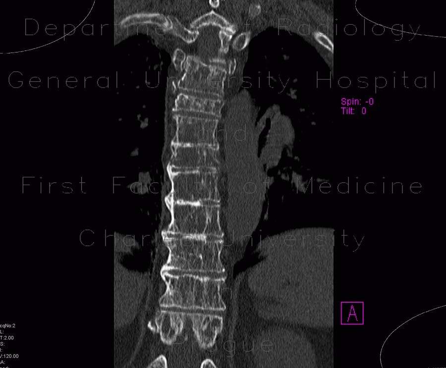 Radiology image - Skeletal changes in myeloma, thoracic spine and ribs: Spine and Axial, Bone: CT - Computed tomography