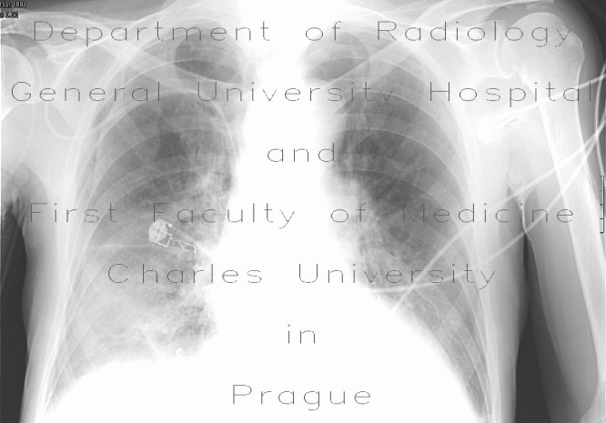 Radiology image - Skin fold mimicking pneumothorax: Thorax, Lung: X-ray - Plain radiograph