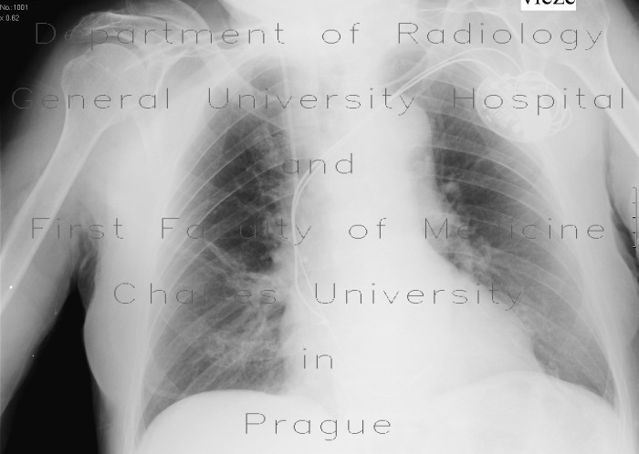 Skin fold on supine chest radiograph