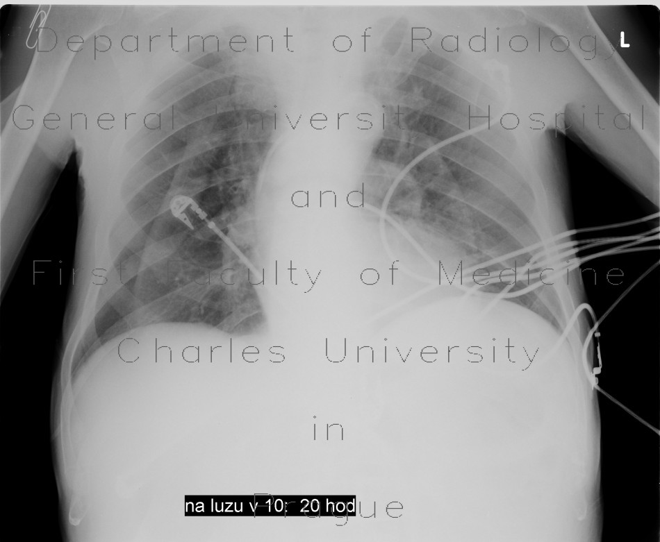 Radiology image - Skin folds, mimic of pneumothorax, PNO: Thorax, Lung, Mediastinum and pleural cavity: X-ray - Plain radiograph