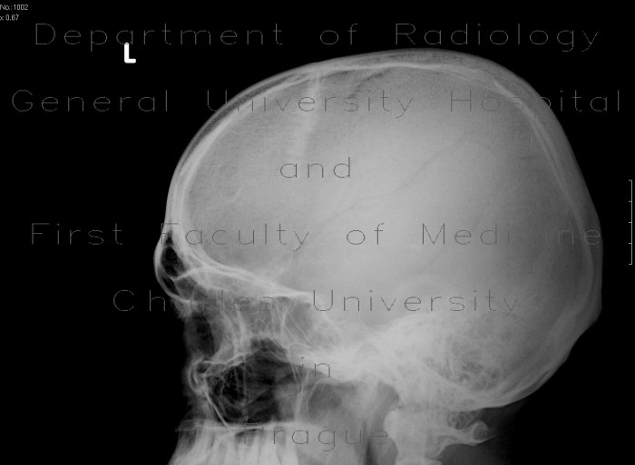 Radiology image - Skull fissure, epidural hematoma: Brain, Bone, Brain: X-ray - Plain radiograph