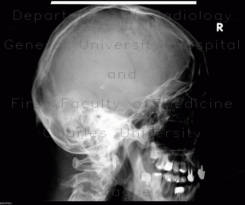 Radiology image - Skull fissure, temporal bone, occipital bone: Head and Neck, Bone: X-ray - Plain radiograph