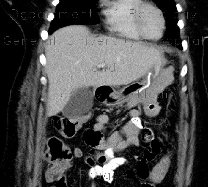 Sleeve gastrectomy