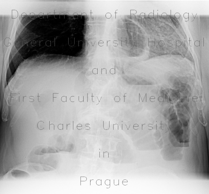 Small bowel ileus