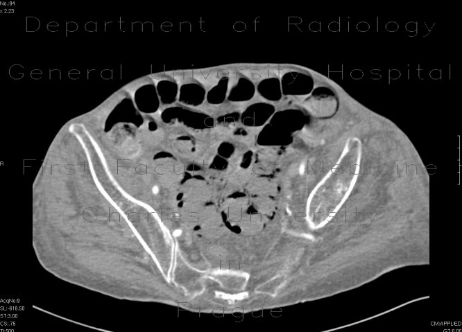 Small bowel ischemia, mesenterial thrombosis