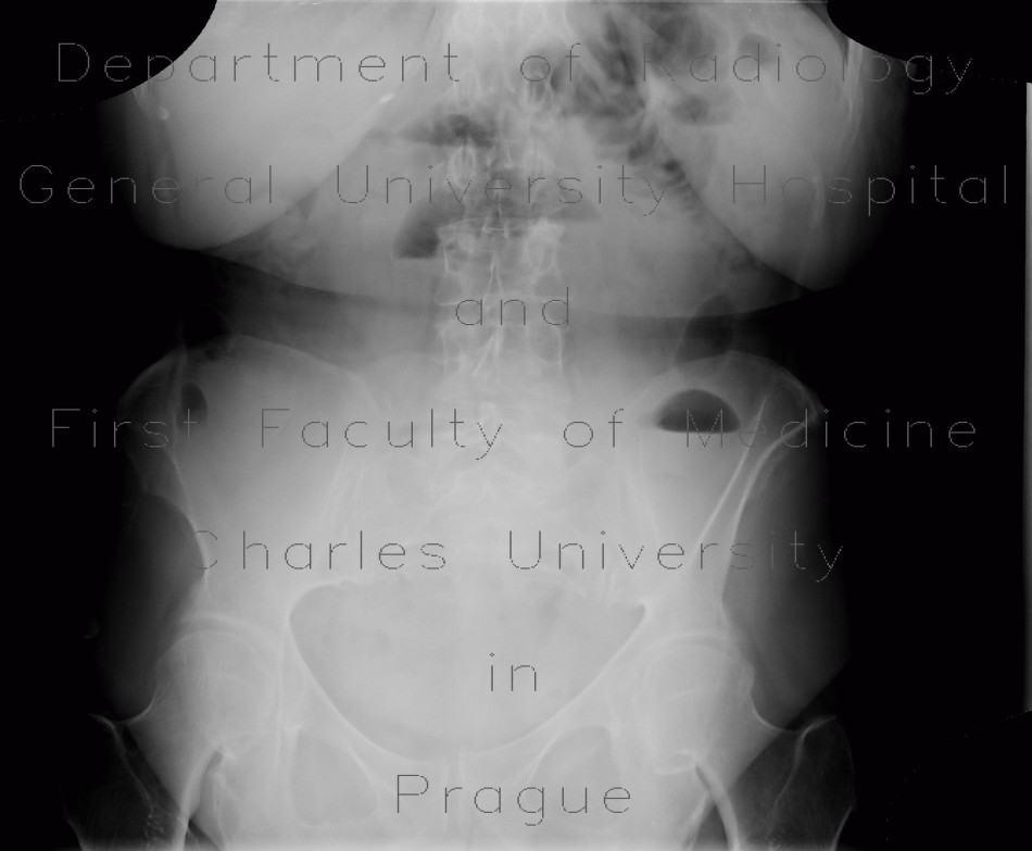 Radiology image - Small bowel obstruction, ileus, Crohn